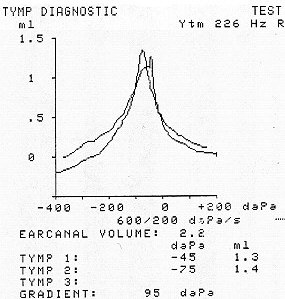 tymp post-