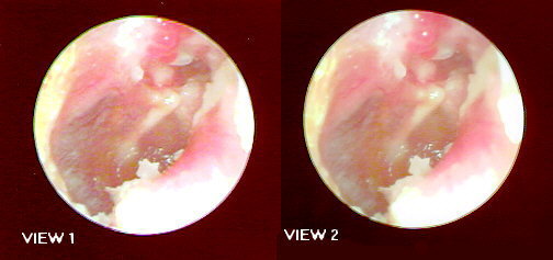 ACQUIRED CHOLESTEATOMA POST TEMPORAL BONE FRACTURE